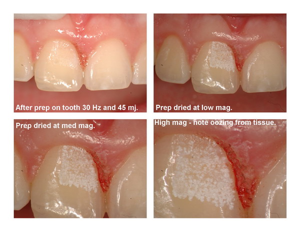 Gingivectomy and restoration Page4_resize.jpg